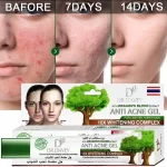 Dr. Davey Dragon's Blood Anti-Acne Gel - 30g - Image 2