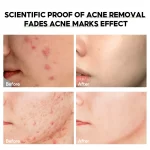 Dr. Davey Dragon's Blood Anti-Acne Gel - 30g - Image 3