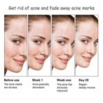 Anti-Acne Whitening Facial Serum 30ml - Aichun Beauty - Image 2
