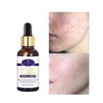 Anti-Acne Whitening Facial Serum 30ml - Aichun Beauty - Image 3