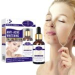 Anti-Acne Whitening Facial Serum 30ml - Aichun Beauty - Image 4